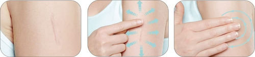 Pomada Mederma Scars Para Cicatrizes 10g