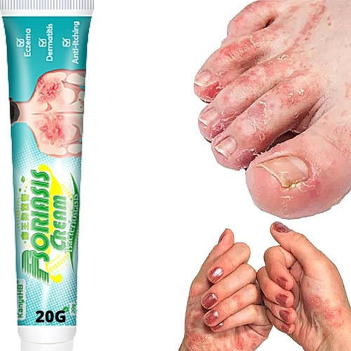 Pomada Para Tratamento Psoríase Eczema Dermatite Coceira