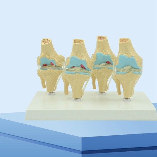Modelo Anatómico De Articulación Degenerativa De La Rodilla