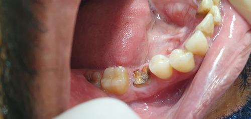 Implantes Inmediatos Post Extracción 