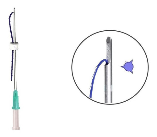 Imagen 2 de 2 de Hilos Tensores Espiculados 3d, Con Cannula W