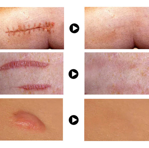 . Crema For Quitar Cicatrices Y Reparar La Piel, 2 Unidades,