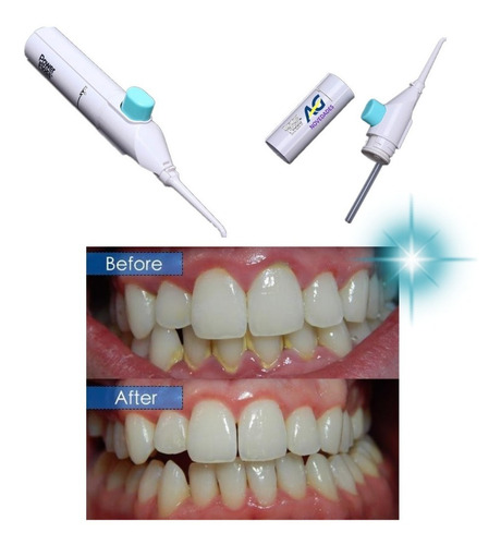 Imagen 1 de 6 de Limpiador Dental Bucal Duchador Irrigador Agnovedades