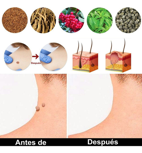 5 Piezas Ungüento Removedor Verrugas Del Herpes Genital
