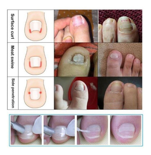 Tiras Correctoras De Uñas Encarnadas, Pinza Para Enderezar