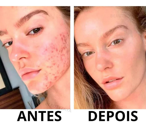 Vitacyd 0,25mg - Ideal P/ Melasma Acne Manchas 100% Original Todo Tipo De Pele Dia/noite