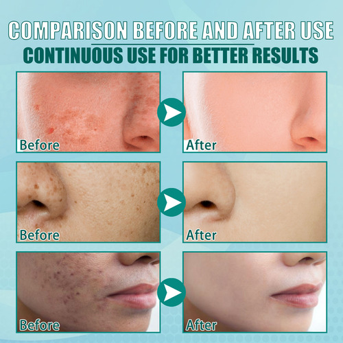 La Crema Blanqueadora Y Eliminadora De Pecas En V Aclara Las
