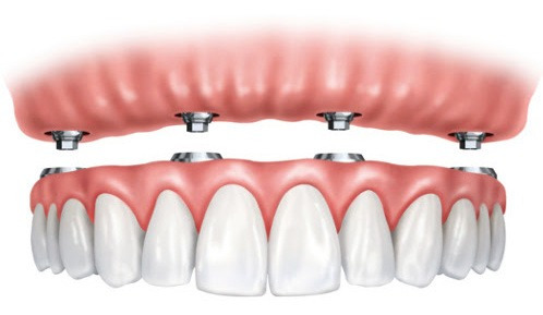 Imagen 3 de 3 de 4 Implantes + Protesis Completa De Acrilico / Osde Y Medife