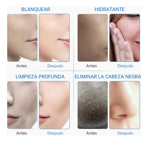 Máquina Hidrofacial 6 En 1 Limpieza Profunda, Microdermoabrasión, Radiofrecuencia, Ultrasonido, Pulverizador, Terapia Fría Profesional Para Spa Y Estética