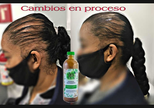 Adiós Calvicie, Alopecia, Psoriasis Pack 5 Shampoo Siloe