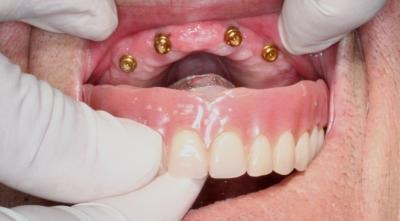 Imagen 2 de 3 de 4 Implantes + Protesis Completa De Acrilico / Osde Y Medife