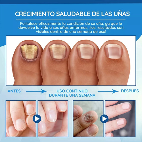 3 Pluma Luz Azul Elimina Hongo Cuidado Uñas Reparación Láser