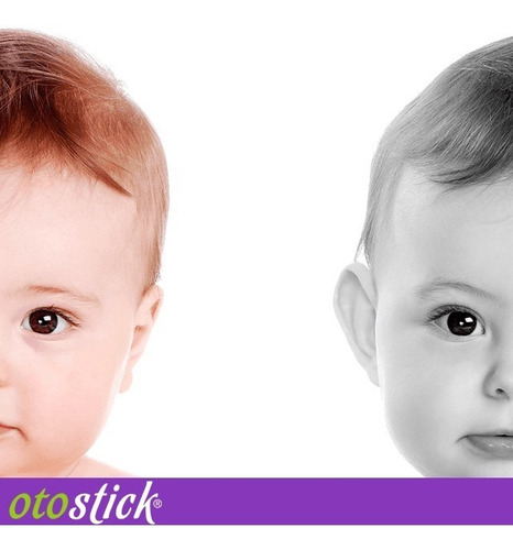 Otostick Bebé, Corrección Definitiva De Orejas Separadas