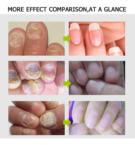 Gel Reparador De Uñas Efero, 2 Unidades, Tratamiento De Uñas