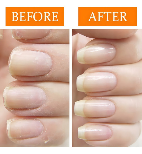 Kit restaurador para unhas danificadas Kit de recuperação Nail Tek