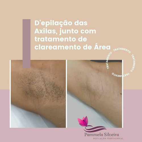 Imagem 1 de 4 de Depilação A Cera E Clareamento De Área
