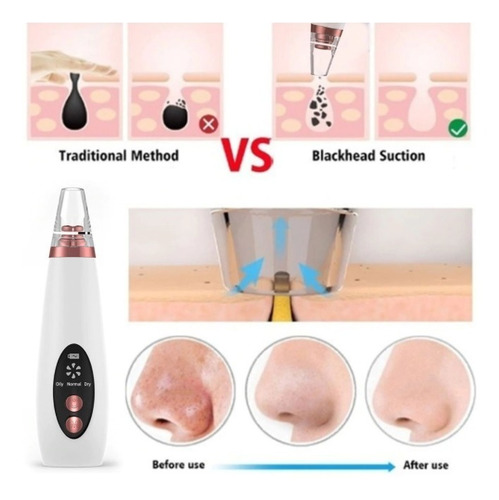 Kit Limpiador Facial Poros Removedor Puntos Negros