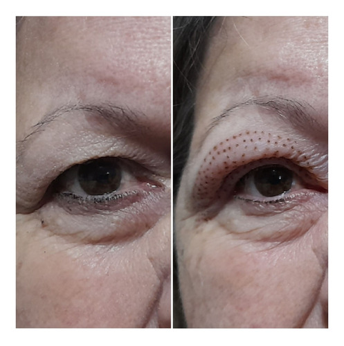 Imagen 2 de 4 de Parpados Caidos. Blefaroplastia No Quirurgica (plasma Laser)