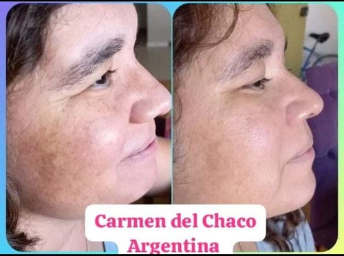 Kit Aclarador Anti Manchas Seytú X2