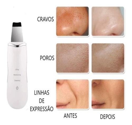 Imagem 4 de 6 de Aparelho Peeling Ultrassonico Limpeza De Pele Anti Espinhas