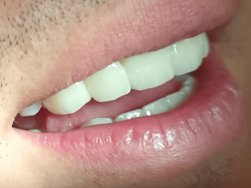 Carillas Dentales De Zirconio
