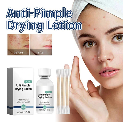 Loción Secante J Pimple De 30 Ml I Con Loción De Óxido I Par