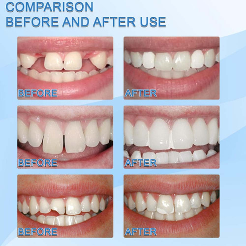 5 Unidades 30 Ml Dientes Postizos Dientes Reparación