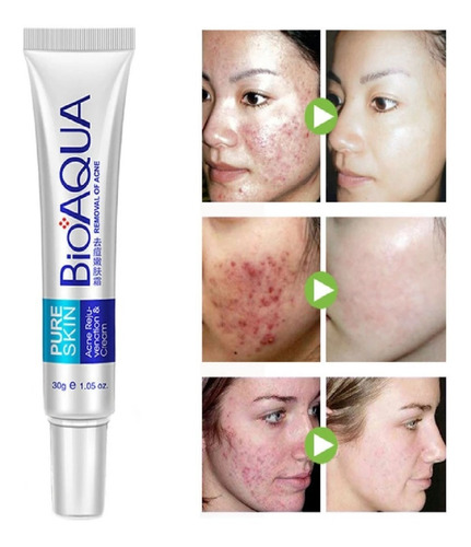 Bioaqua Crema Anti Acné Cicatriz Elimina Manchas Espinillas