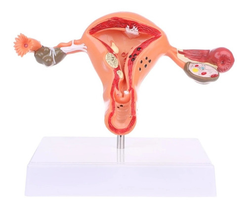 Modelo Anatómico Útero Y Ovarios Patológicos