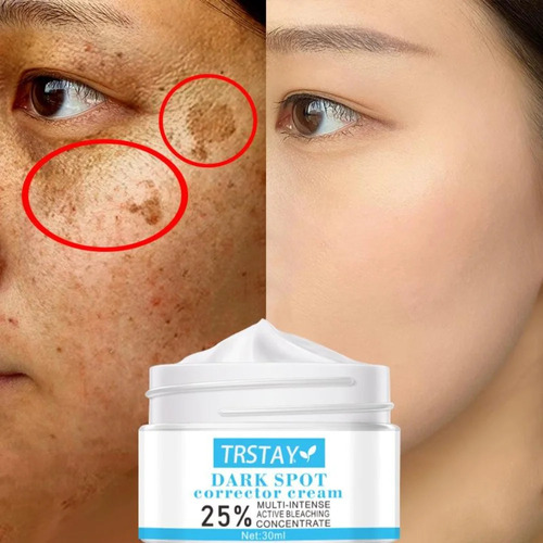 Las Manchas De Pecas Aclaran El Melasma, Crema Eliminadora D