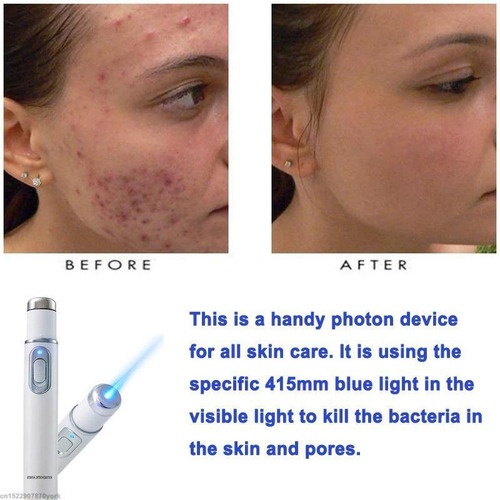 Caneta Tratamento Varizes/acne E Cicatrizes - Luz Led