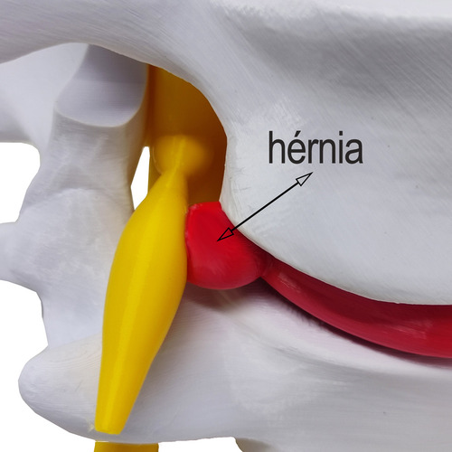 Modelo Anatômico Hérnia Disco Coluna Vertebral 3d