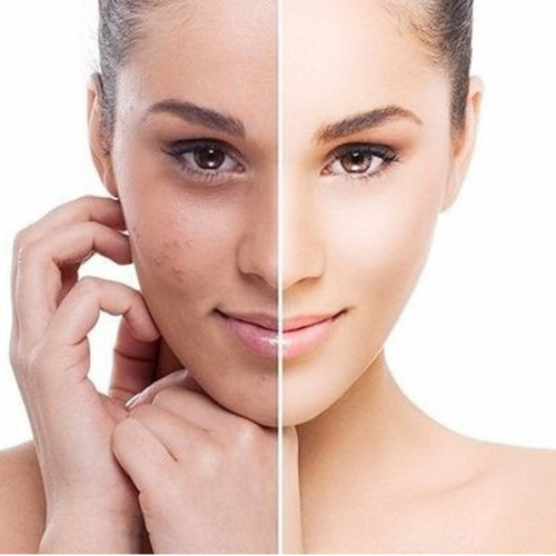 Imagen 5 de 7 de Gel Mandelico Para Manchas Marcas Cicatrices De Acne Idraet