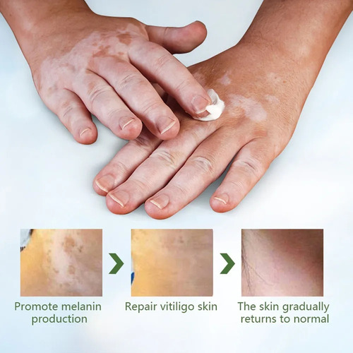 2creme Para Vitiligo, Creme Para Remover Manchas Brancas