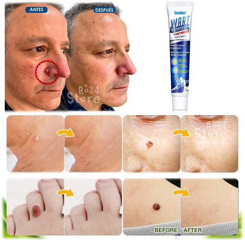 Imagen 3 de 10 de 2 Unid Elimina Verruga Papiloma Lunar Rostro Cuerpo Genital