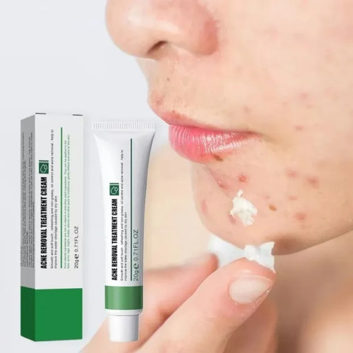 --fb Crema Para El Tratamiento Del Acné De Espalda, Crema
