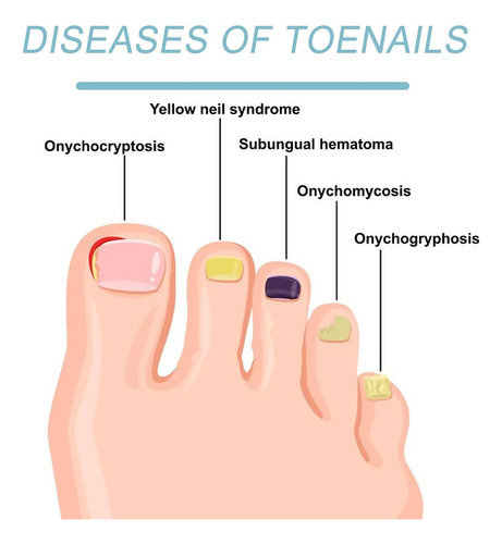 Tratamiento Láser De Hongos En Las Uñas Y Onicomicosis