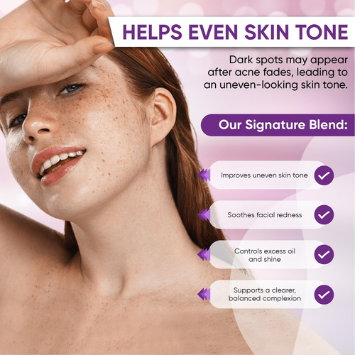 Crema Para El Acné Aobbiy Azelaic Acid Para Rostro 30 Ml