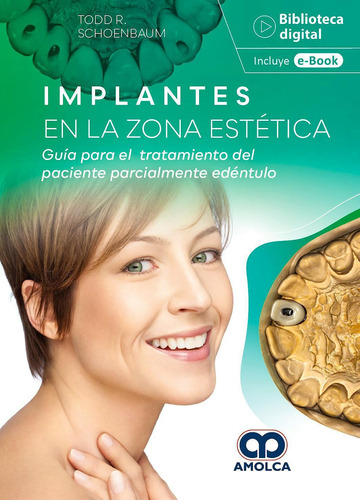 Implantes En La Zona Estetica - Schoembaum