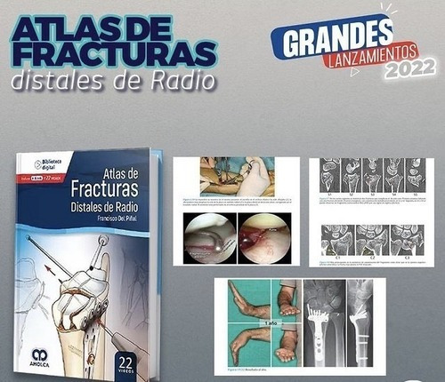 Atlas De Fracturas Distales De Radio  Ebook,jk
