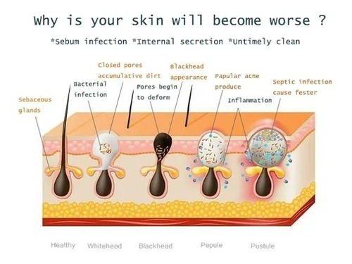 Acné Espinilla De Succión Microdermoabrasión Blackhead Instr
