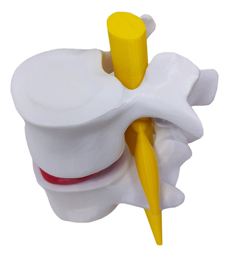 Modelo Anatômico Hérnia Disco Coluna Vertebral 3d