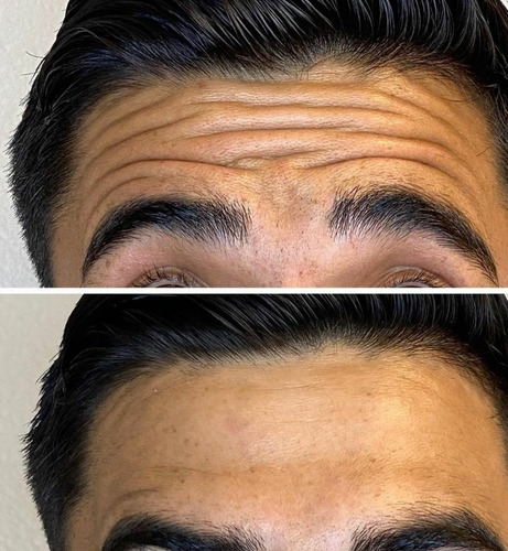 Imagem 1 de 10 de Aplicação Enzimas Gordura Skinbooster Papada Estria Celulite