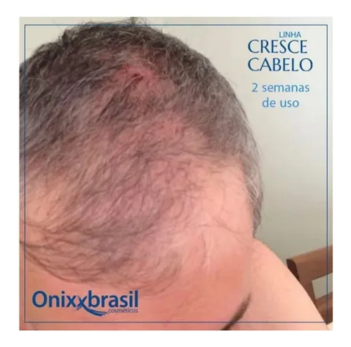 Tônico Capilar Nasce Cabelo Onixx Brasil 120ml Shampoo Minox