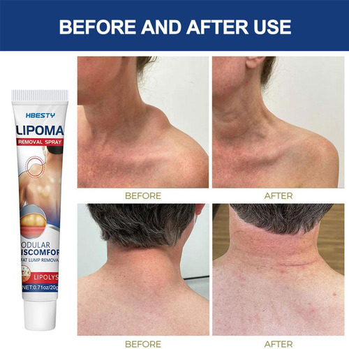3pcs Creme De Tratamento Para As Borbulhas Da Celulite