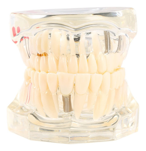 Modelo De Implante Dental Transparente