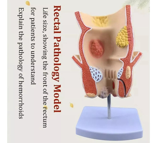 Yi Modelo Recto Patológico Humano, Modelo Recto Dañado