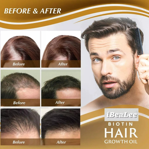 - Óleos De Crescimento Em Spray Para Cabelo Anti-queda De