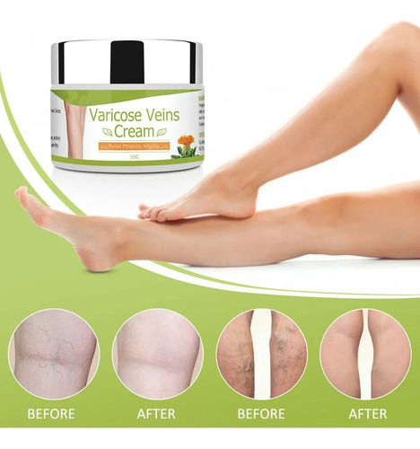 Crema For Venas P: Alivia El Dolor, Las Venas Y Las Protube-