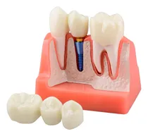 Comprar Modelo Educativo De Implante Dental, Corona Y Puente